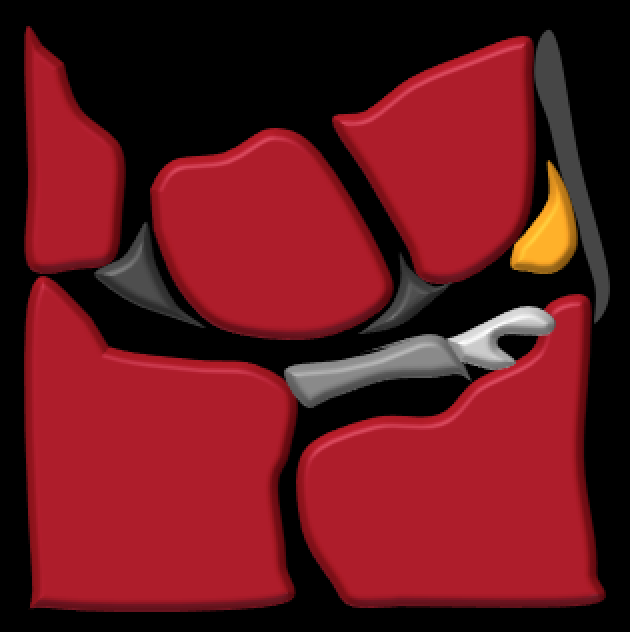 TFCC coronal anatomy